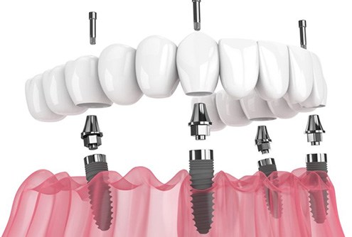 Illustration of All-on-4 dental implants for lower arch