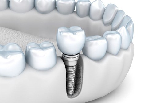 Illustration of dental implant in jawbone against white background