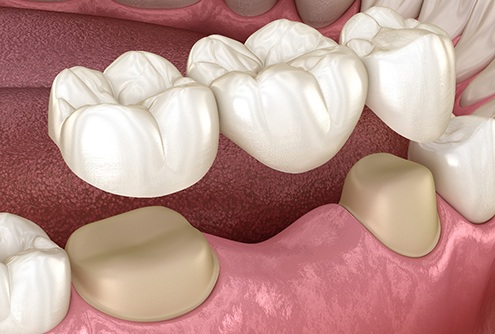 Illustration of dental bridge being placed on teeth