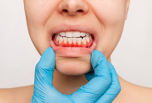 A woman revealing her red and inflamed gums