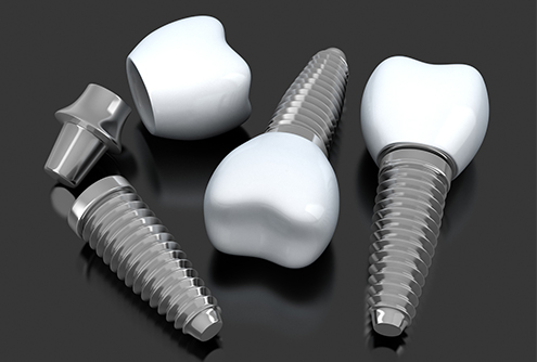 Closeup of dental implants in McMinnville 