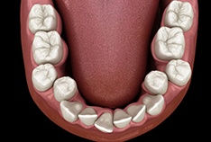 Illustration of crooked teeth