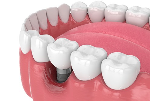 Illustration of failed dental implant in McMinnville, OR