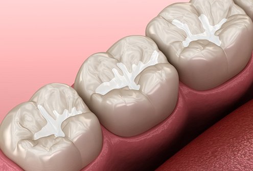 a 3D illustration of dental sealants on molars