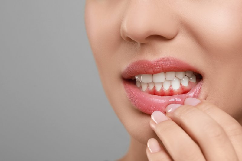 A closeup of a woman with gingivitis